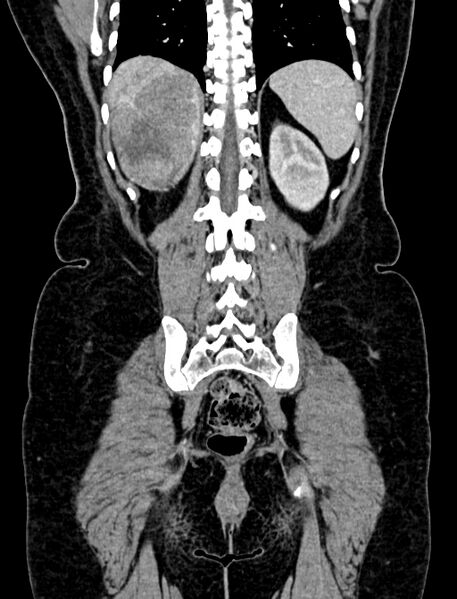 File:Adrenocortical carcinoma (Radiopaedia 87281-103569 Coronal C+ portal venous phase 114).jpg