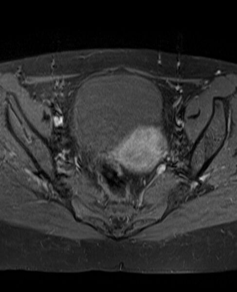File:Adult granulosa cell tumor of the ovary (Radiopaedia 71581-81950 Axial T1 C+ fat sat 14).jpg