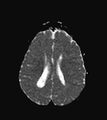 Aicardi syndrome (Radiopaedia 66029-75205 Axial ADC 15).jpg
