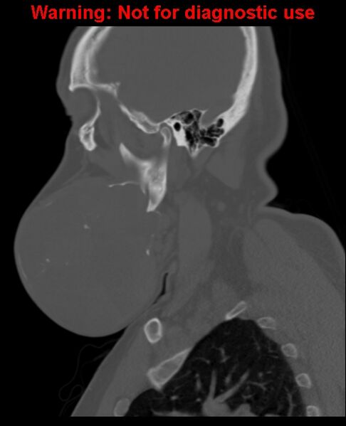 File:Ameloblastoma (Radiopaedia 33126-34164 Sagittal bone window 23).jpg