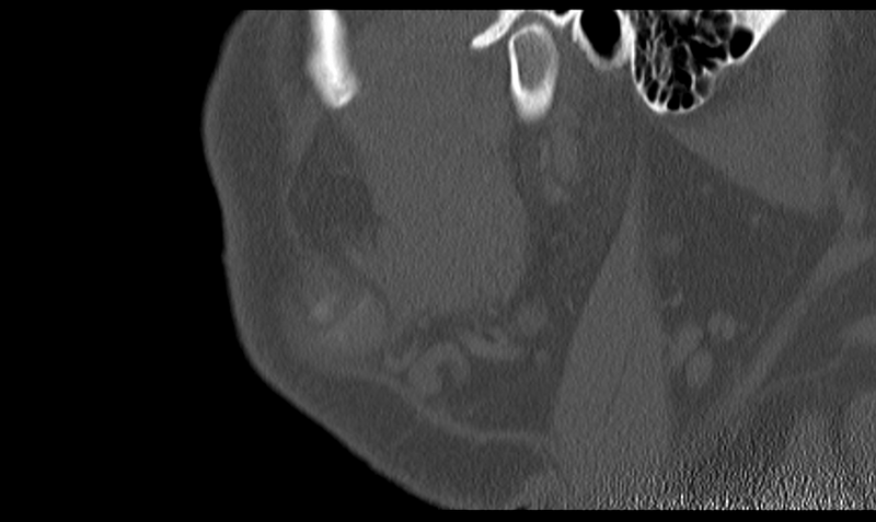 File:Ameloblastoma (Radiopaedia 33677-34806 Sagittal bone window 14).png