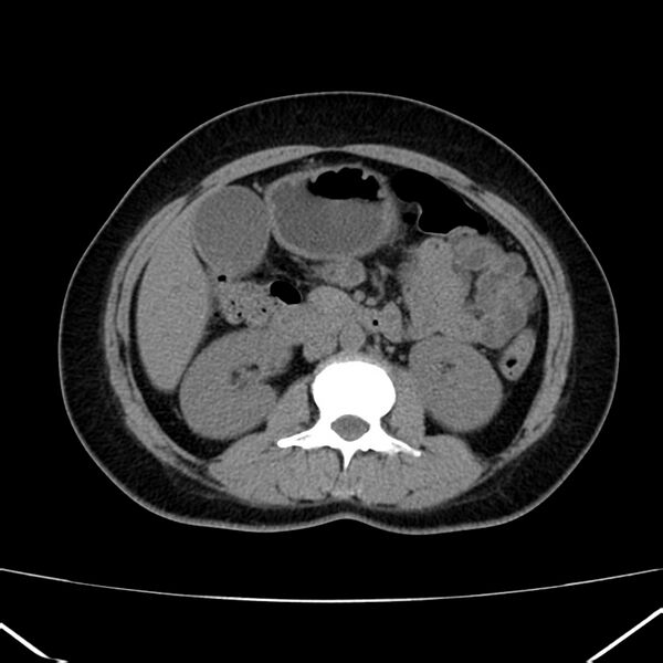 File:Ampullary tumor (Radiopaedia 22787-22816 Axial non-contrast 25).jpg