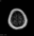 Amyotrophic lateral sclerosis (Radiopaedia 5373-7134 Axial FLAIR 23).jpg