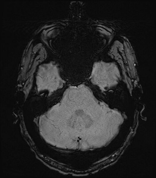 File:Amyotrophic lateral sclerosis (Radiopaedia 87352-103658 Axial SWI 10).jpg
