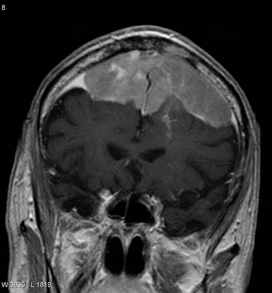 File:Anaplastic meningioma (Radiopaedia 5553-7290 H 1).jpg
