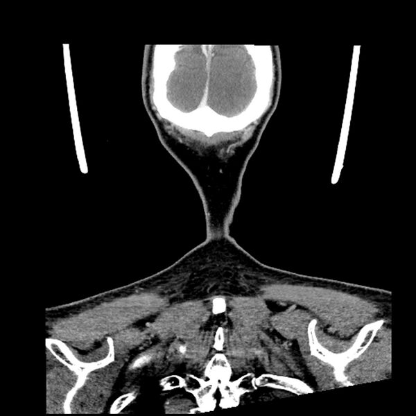 File:Anaplastic thyroid carcinoma (Radiopaedia 79087-92034 A 109).jpg