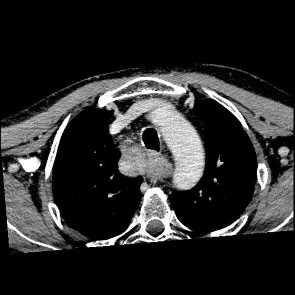 File:Anaplastic thyroid carcinoma (Radiopaedia 79087-92034 B 10).jpg
