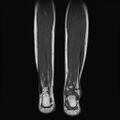 Aneurysmal bone cyst - tibia (Radiopaedia 22343-22367 Coronal T1 14).jpg