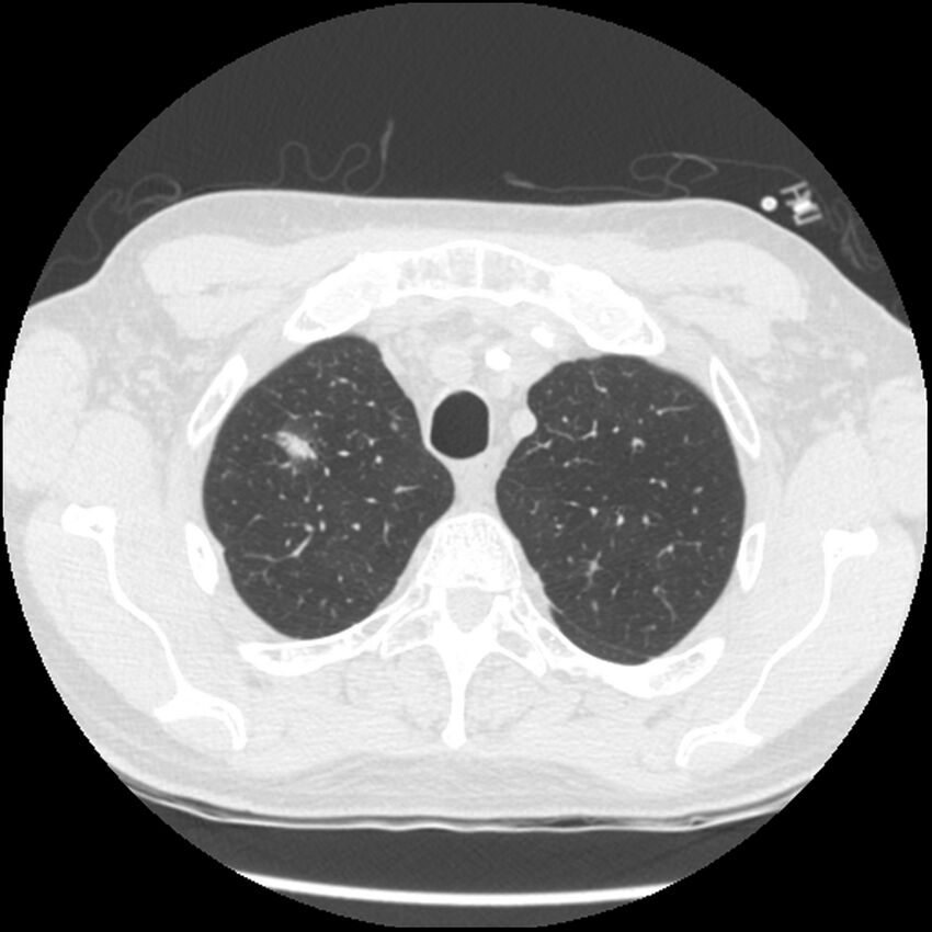 Angioinvasive aspergillosis (Radiopaedia 43957-47466 Axial lung window 14).jpg