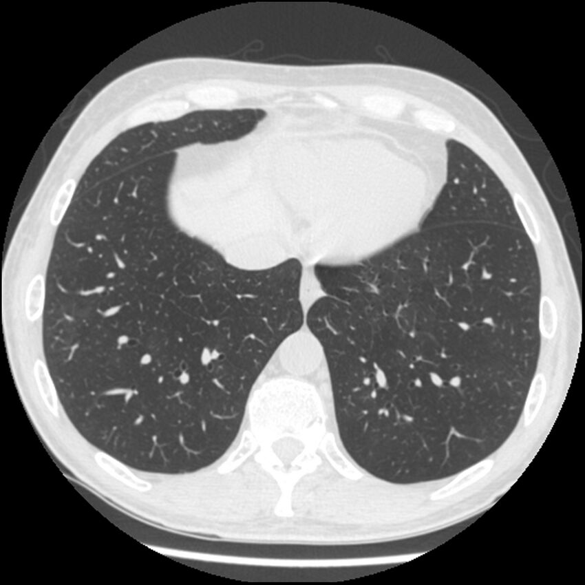 Angioinvasive aspergillosis (Radiopaedia 43957-47466 Axial lung window 52).jpg