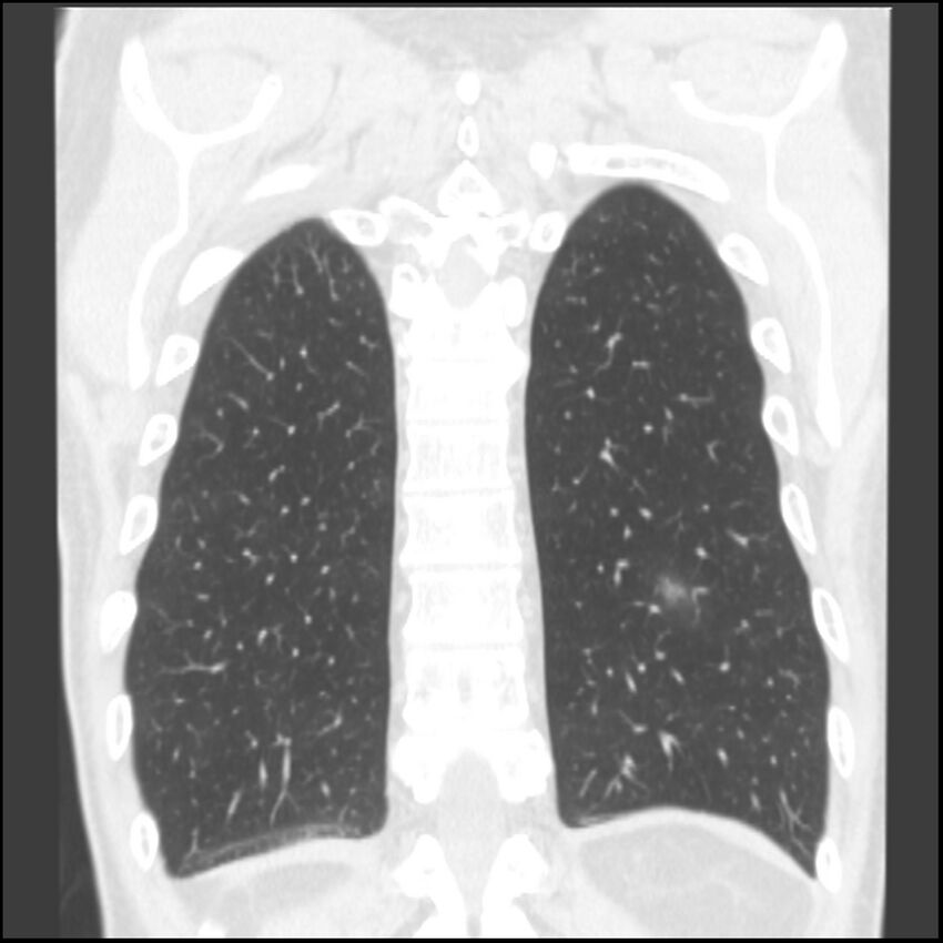 Angioinvasive aspergillosis (Radiopaedia 43957-47466 Coronal lung window 16).jpg