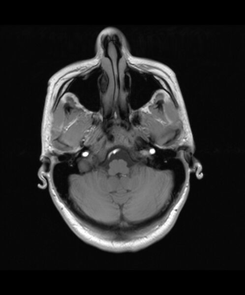 File:Angiomatous meningioma (Radiopaedia 79459-92579 Axial T1 4).jpg