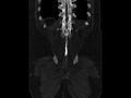 Ankylosing spondylitis (Radiopaedia 44609-48357 Coronal bone window 93).jpg