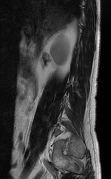 File:Ankylosing spondylitis - Andersson lesion (Radiopaedia 81878-95838 Sagittal T2 1).jpg