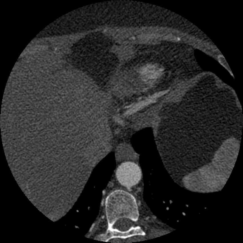 Anomalous origin of left circumflex artery from right coronary sinus (Radiopaedia 72563-83117 B 165).jpg