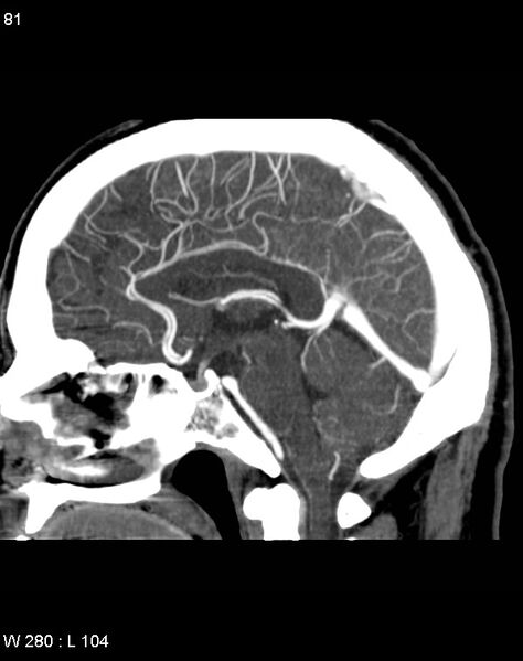 File:Anterior cerebral artery terminal branches (Radiopaedia 36127).jpg