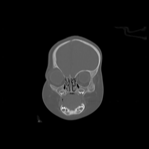 File:Anterior plagiocephaly (Radiopaedia 71836-82273 Coronal bone window 14).jpg