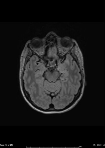 File:Anterior temporal lobe perivascular space (Radiopaedia 40946-43650 Axial FLAIR 11).jpg