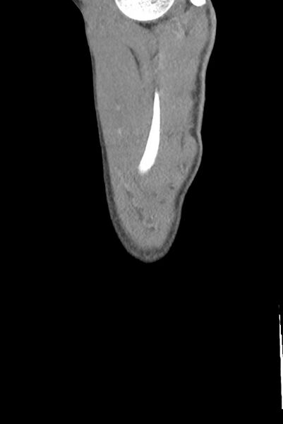 File:Aortic coarctation with aneurysm (Radiopaedia 74818-85828 B 159).jpg