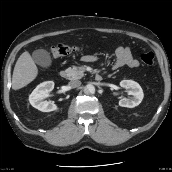File:Aortic dissection- Stanford A (Radiopaedia 37759-39664 A 93).jpg