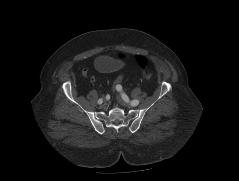 File:Aortic dissection (Radiopaedia 28802-29105 A 86).jpg