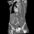 Aortic dissection (Radiopaedia 68763-78691 B 19).jpeg
