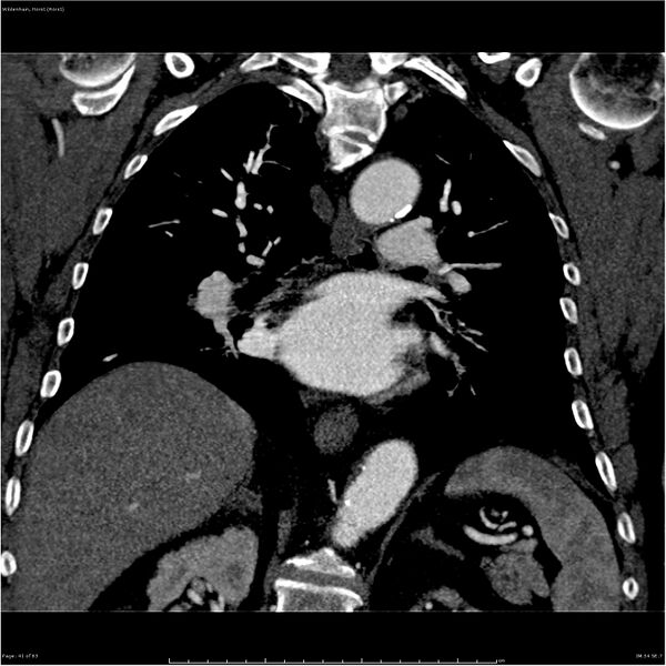 File:Aortic dissection - Stanford type A (Radiopaedia 26183-26315 A 41).jpg