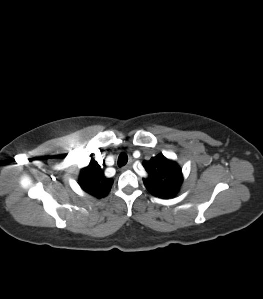 File:Aortic dissection with renal ischemia (Radiopaedia 76573-88338 A 6).jpg