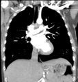 Aortic valve non-coronary cusp thrombus (Radiopaedia 55661-62189 C 39).png