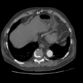 Aorto-coronary bypass graft aneurysms (Radiopaedia 40562-43157 A 99).png