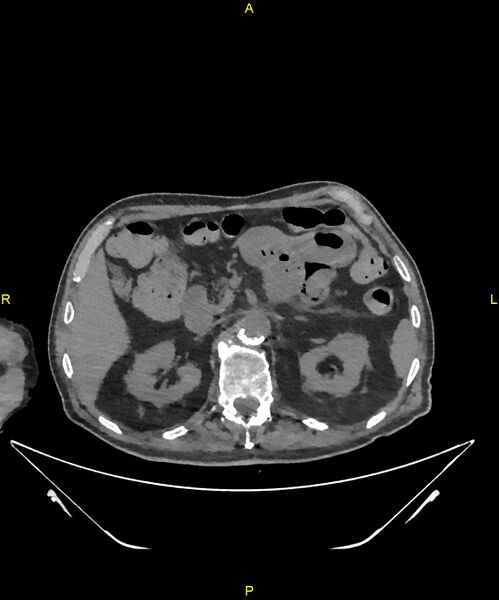 File:Aortoenteric fistula (Radiopaedia 84308-99603 Axial non-contrast 101).jpg