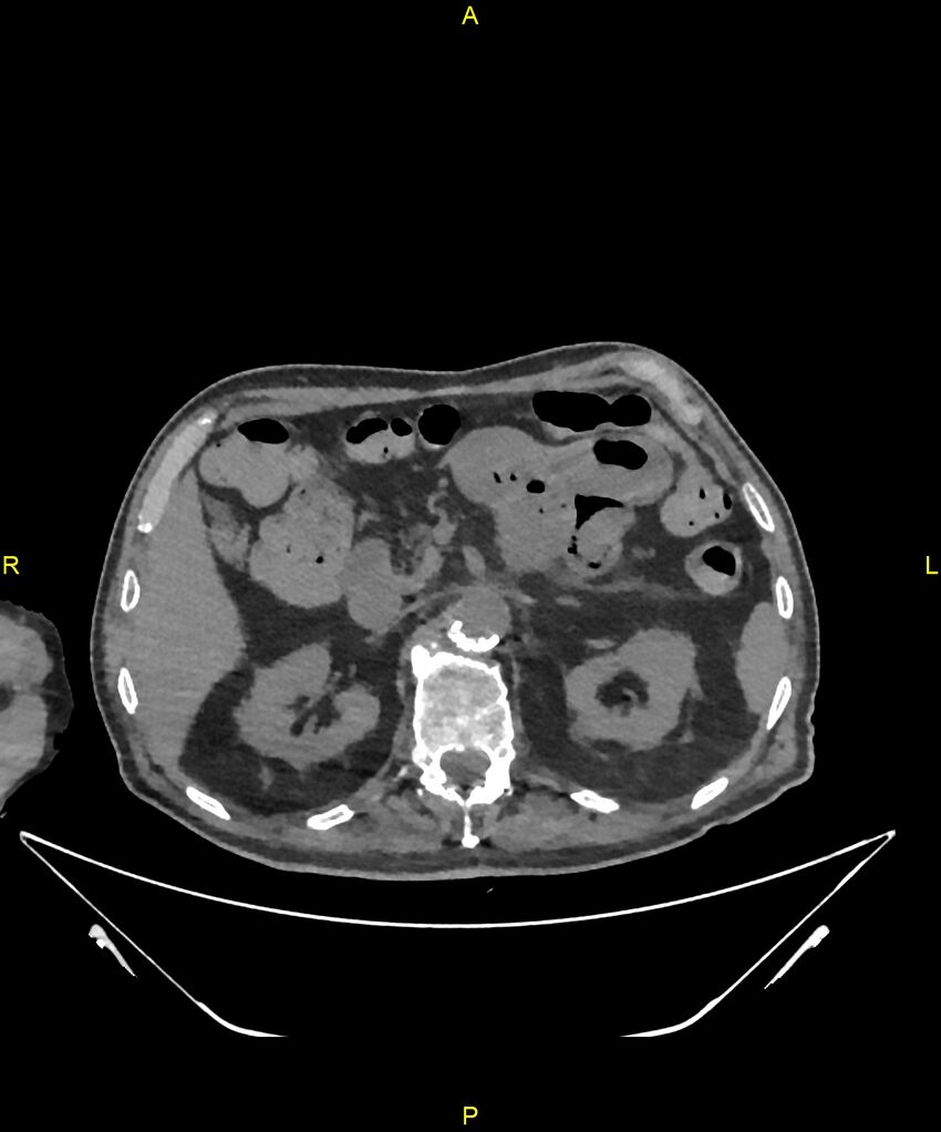 Aortoenteric fistula (Radiopaedia 84308-99603 Axial non-contrast 101).jpg