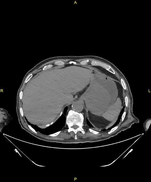 File:Aortoenteric fistula (Radiopaedia 84308-99603 Axial non-contrast 42).jpg