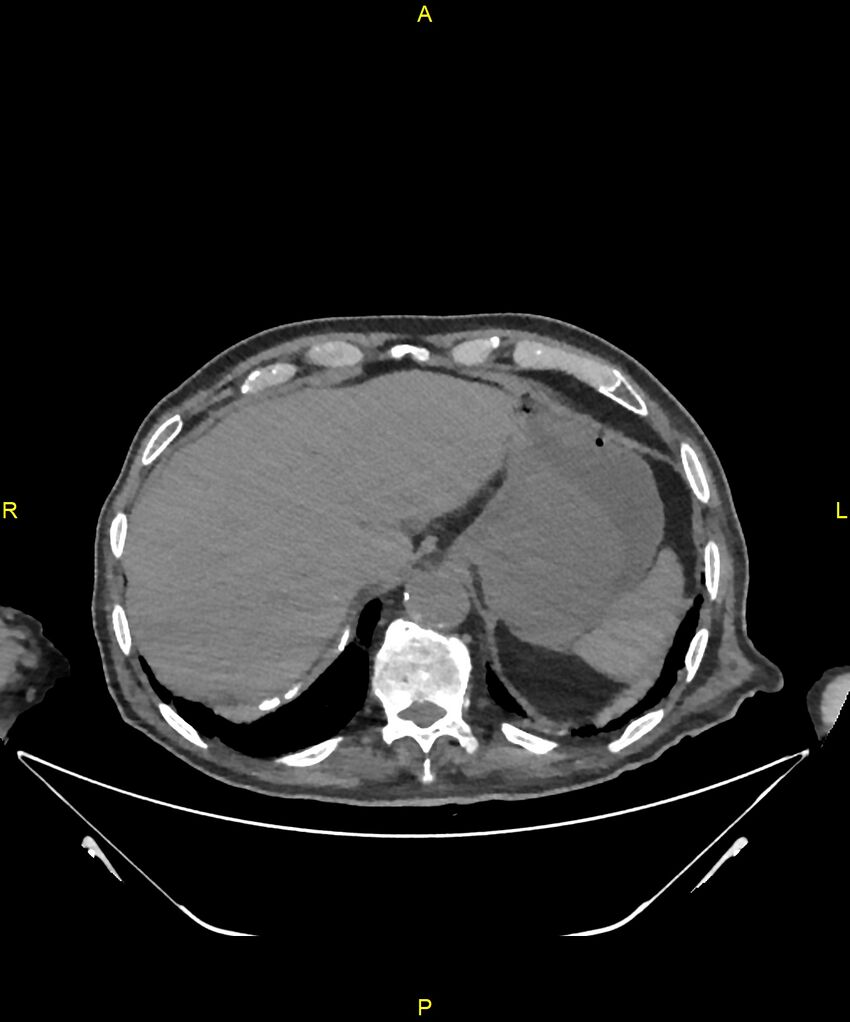 Aortoenteric fistula (Radiopaedia 84308-99603 Axial non-contrast 42).jpg