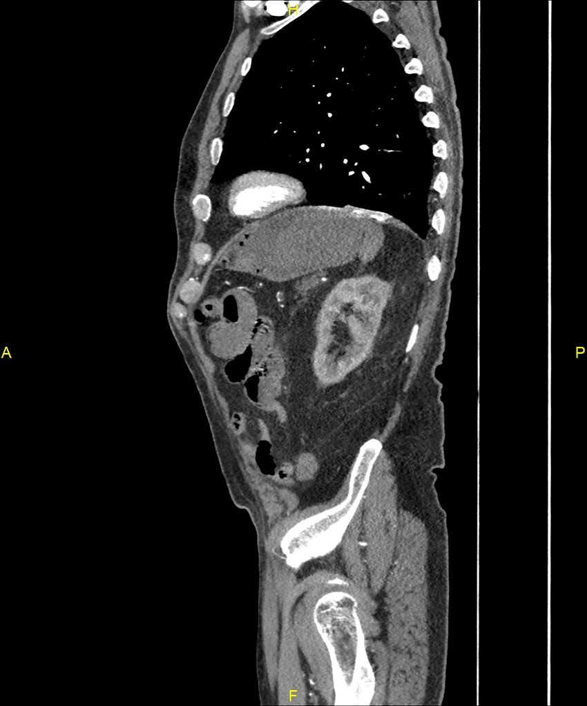 Aortoenteric fistula (Radiopaedia 84308-99603 C 265).jpg