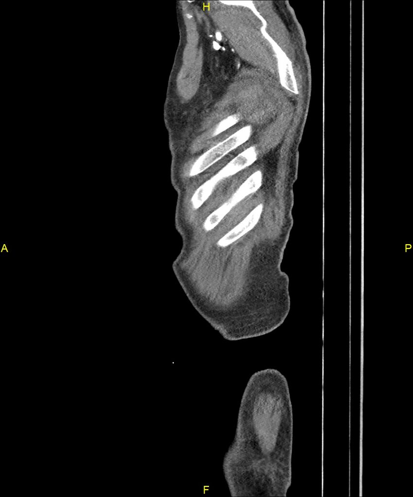 Aortoenteric fistula (Radiopaedia 84308-99603 C 327).jpg