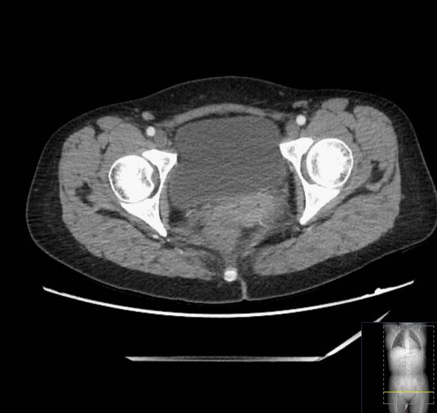 File:Appendicitis (CT angiogram) (Radiopaedia 154713-127660 Axial 68).jpg