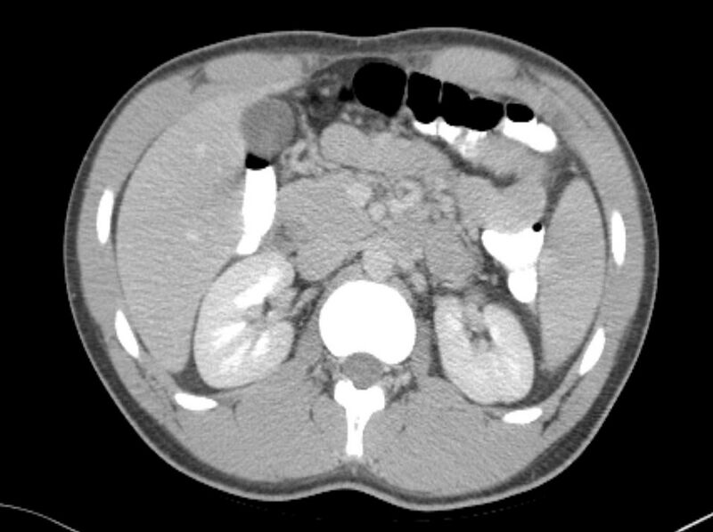 File:Appendicitis and incidental foregut duplication cyst (Radiopaedia 52962-58916 A 14).jpg