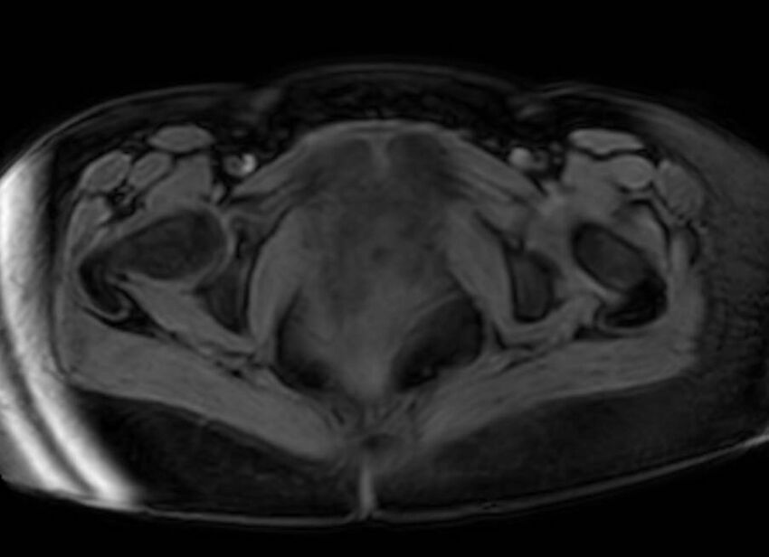 Appendicitis in gravida (MRI) (Radiopaedia 89433-106395 Axial DIXON 147).jpg