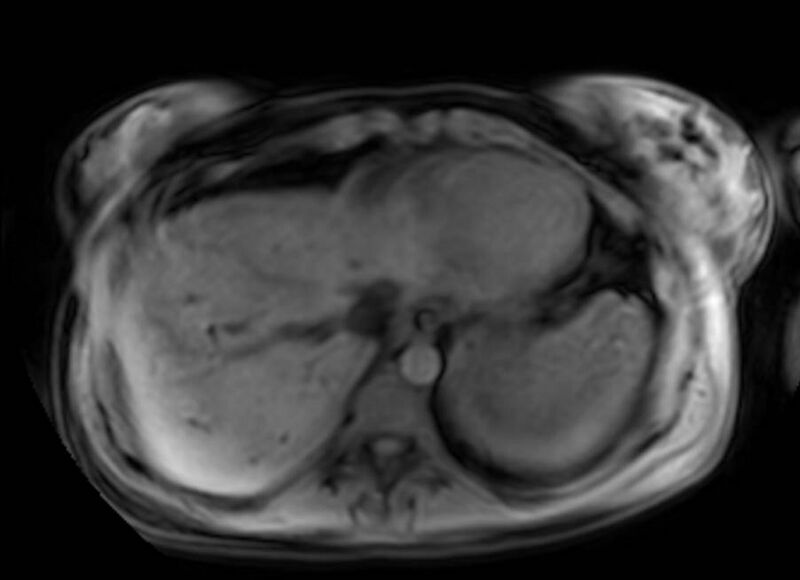 File:Appendicitis in gravida (MRI) (Radiopaedia 89433-106395 Axial DIXON 5).jpg