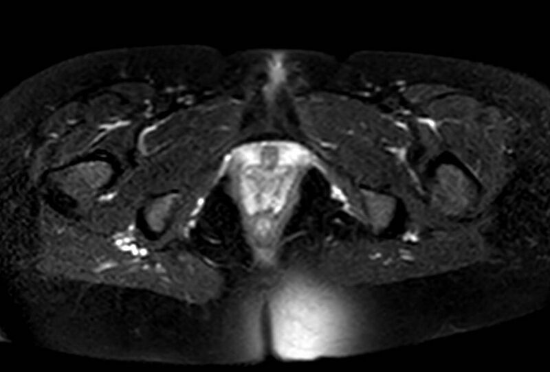 File:Appendicitis in gravida (MRI) (Radiopaedia 89433-106395 Axial T2 SPAIR 78).jpg