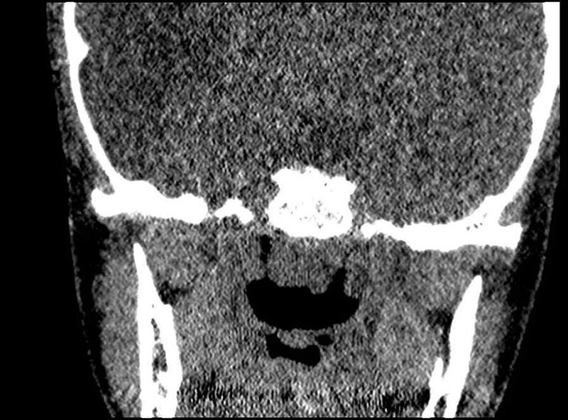 File:Arachnoid cyst- extremely large (Radiopaedia 68741-78450 Coronal bone window 5).jpg