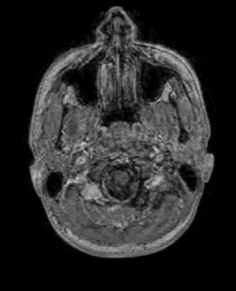 File:Arachnoid cyst- extremely large (Radiopaedia 68741-78451 Axial T1 C+ 10).jpg