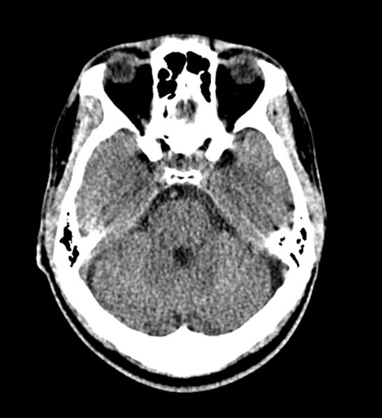 File:Arachnoid cyst of the ambient cistern (Radiopaedia 81301-94986 Axial non-contrast 22).jpg