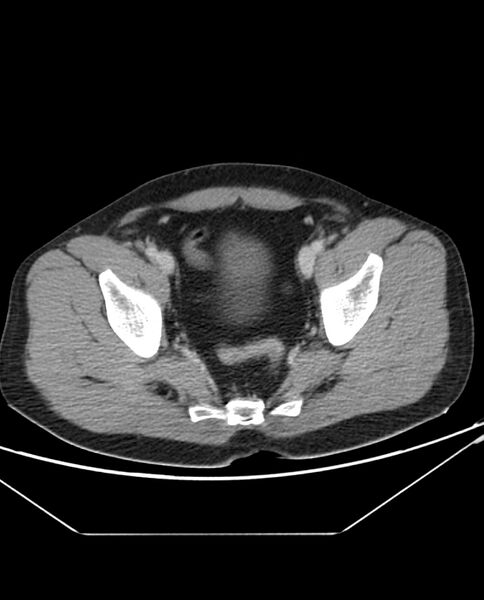 File:Arterial occlusive mesenteric ischemia (Radiopaedia 84641-100054 A 105).jpg