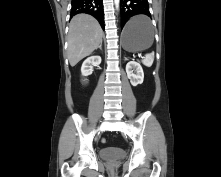 File:Arterial occlusive mesenteric ischemia (Radiopaedia 84641-100060 B 37).jpg