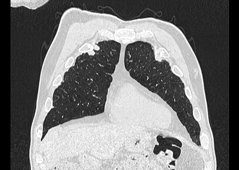 File:Asbestos pleural placques (Radiopaedia 57905-64872 Coronal lung window 44).jpg