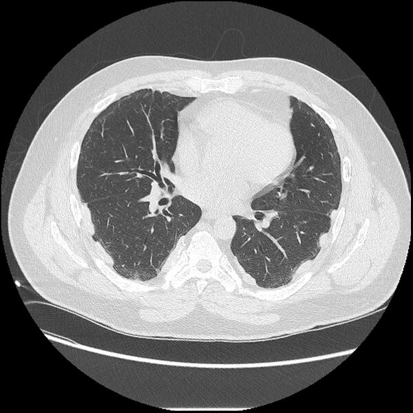 File:Asbestosis (Radiopaedia 45002-48961 Axial lung window 28).jpg