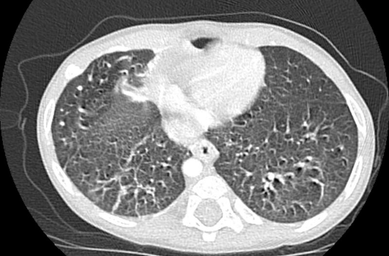File:Asplenia syndrome (Radiopaedia 73083-83792 Axial lung window 57).jpg