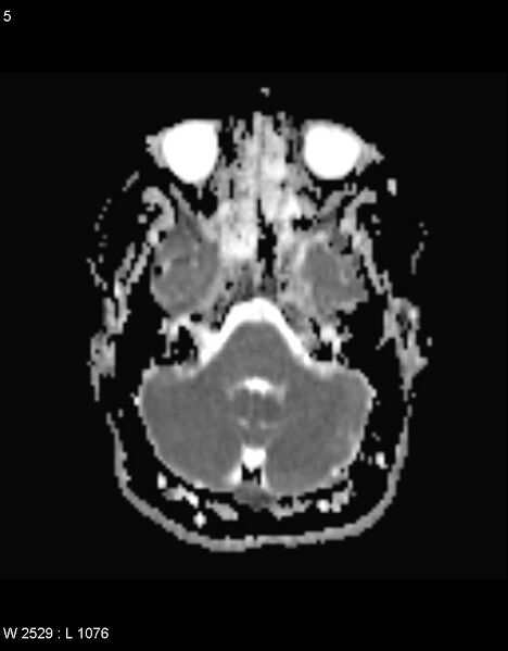File:Astroblastoma (Radiopaedia 39792-42217 Axial ADC 4).jpg